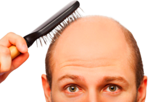 Alopecia areata e perdita di capelli: cause, come si cura e possibili rimedi
